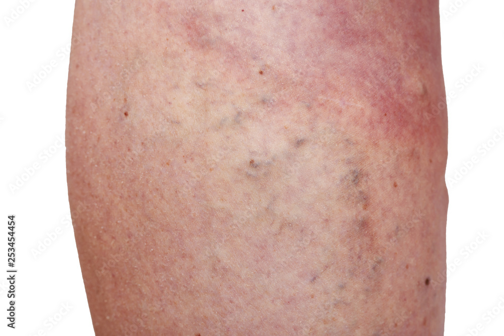 Fototapeta premium The varicose veins