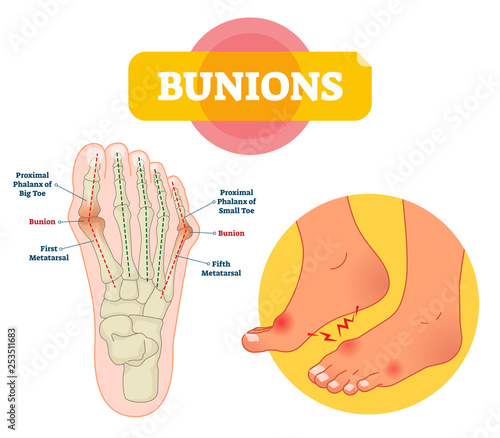 Bunions vector illustration. Labeled feet bone disorder explanation scheme.
