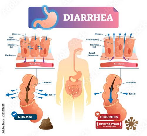 Diarrhea vector illustration. Labeled stomach gut illness medical scheme. photo