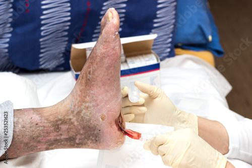 treatment of diabetic foot syndrome