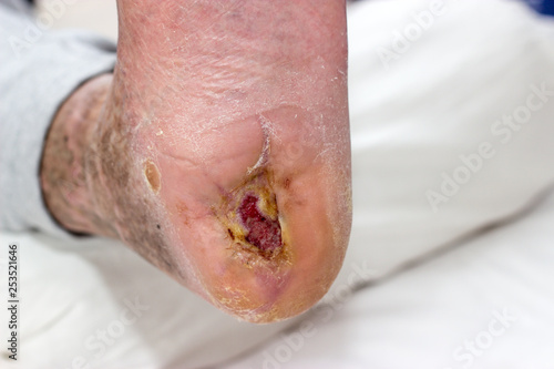 ulcer on a diabetic foot photo