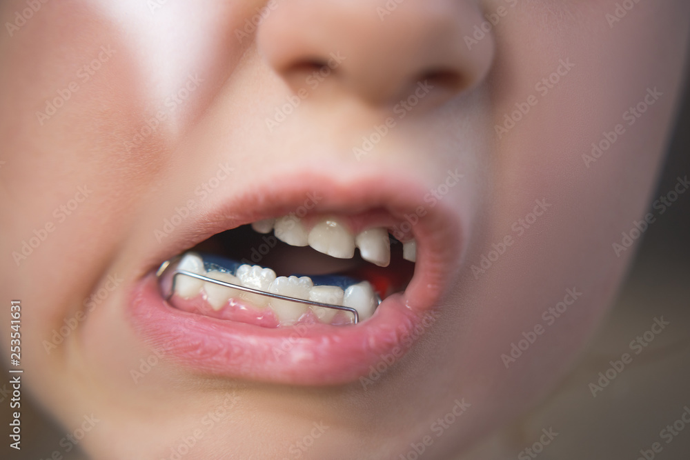 Obraz premium Photo of a little girl's mouth with an orthodontic appliance and crooked teeth.