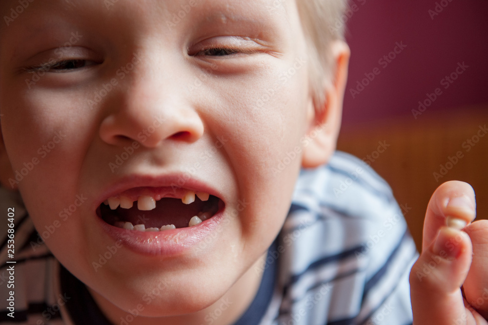 Cute baby shows dropped baby tooth. Boy smiles with toothless mouth. Striped home pajamas, proton purple background Cute baby shows dropped baby tooth. Boy smiles with toothless mouth. Striped home pajamas, proton purple background