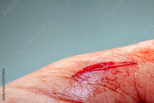 One photo of a series of photos taken of a fresh bleeding cut development over a priod of 90 minutes