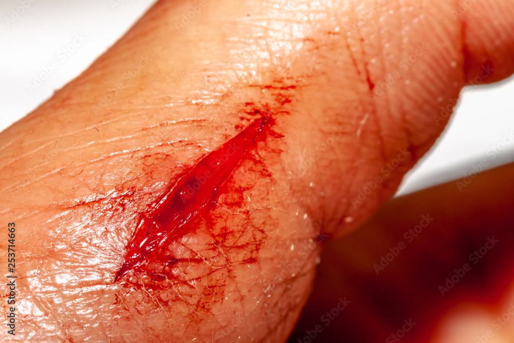 Fototapeta premium One photo of a series of photos taken of a fresh bleeding cut development over a priod of 90 minutes