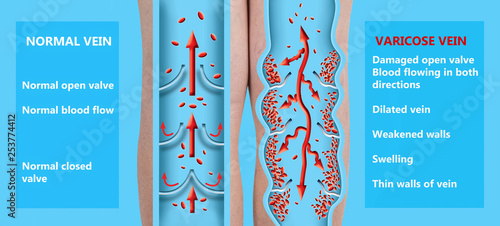 Varicose veins on a female senior legs. The structure of normal and varicose veins.