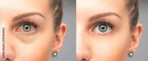 Woman red eyes before and after eye drops wash photo