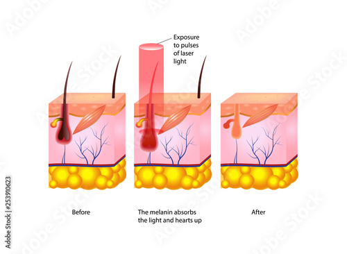 Laser hair removal image infographic design. Aesthetic medicine poster.