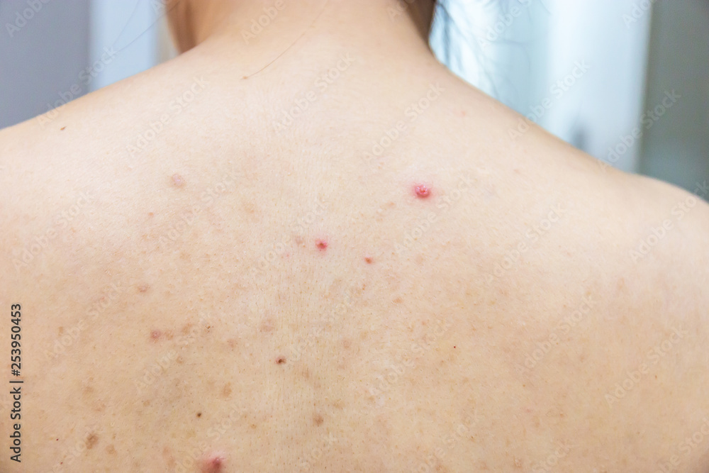 Women with spots on the back, problem with the skin Stock Photo Adobe Stock