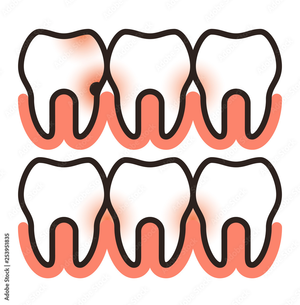 Toothache and paradontosis Toothache and paradontosis