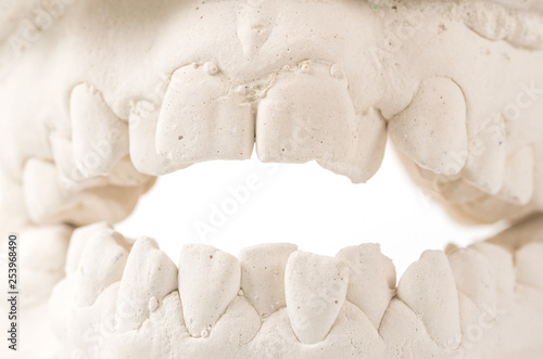 Dental casting gypsum model of human jaws. Crooked teeth and distal bite. Shots were made before treatment with braces . Technical shots on gray background