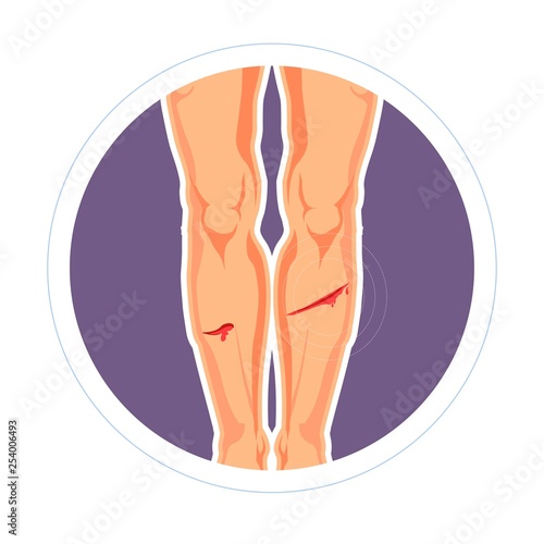 Injury skin cut or scratch legs pain bleeding