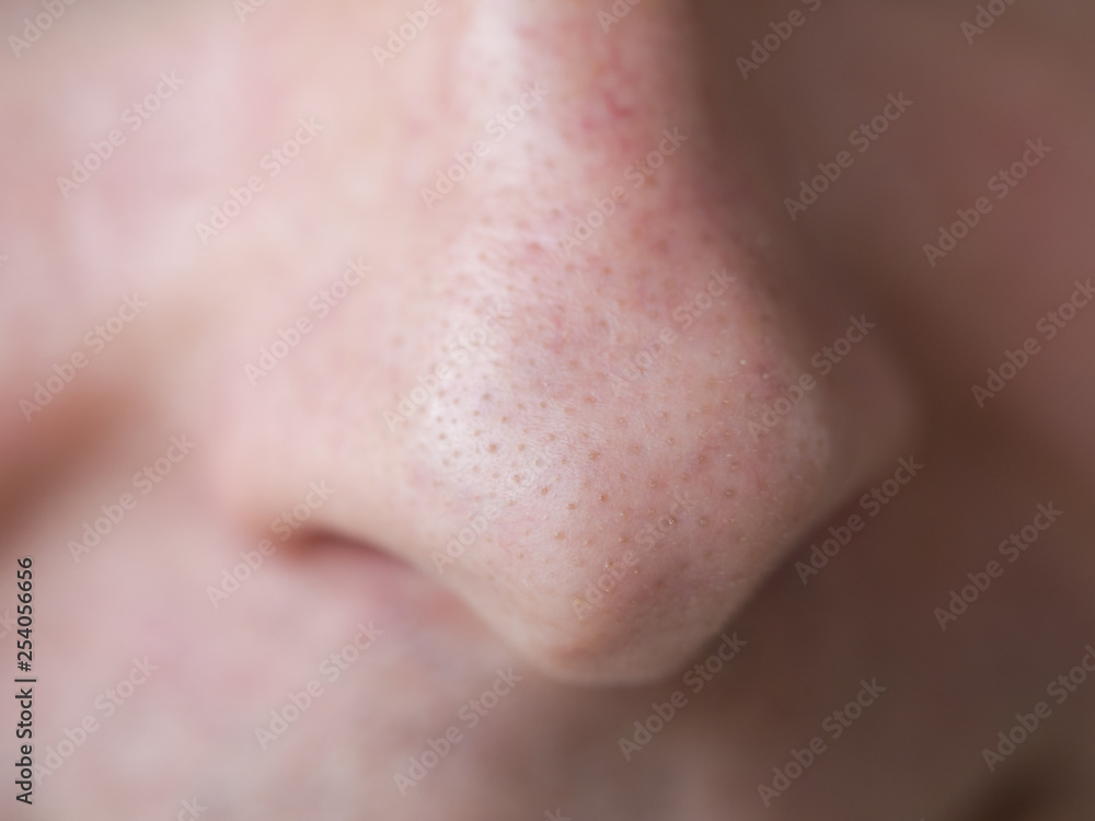Pimple blackheads on the nose. Close up. Pimple blackheads on the nose. Close up.