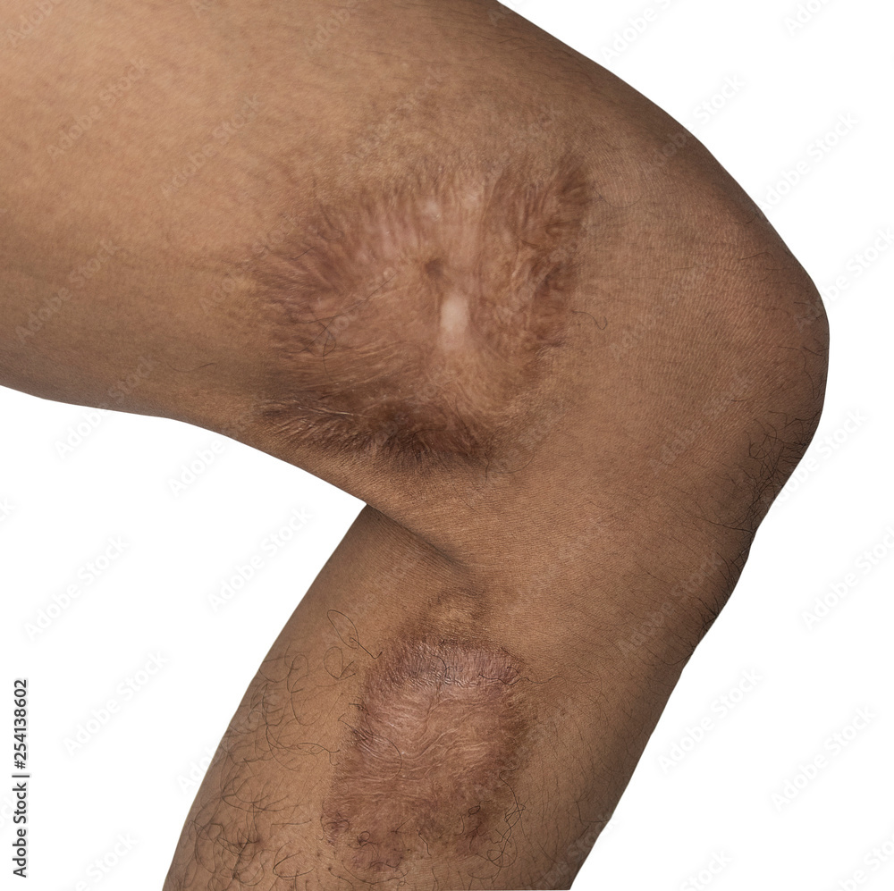 Large scars on the skin of men 's legs. This image is embedded clipping path. Large scars on the skin of men 's legs. This image is embedded clipping path.