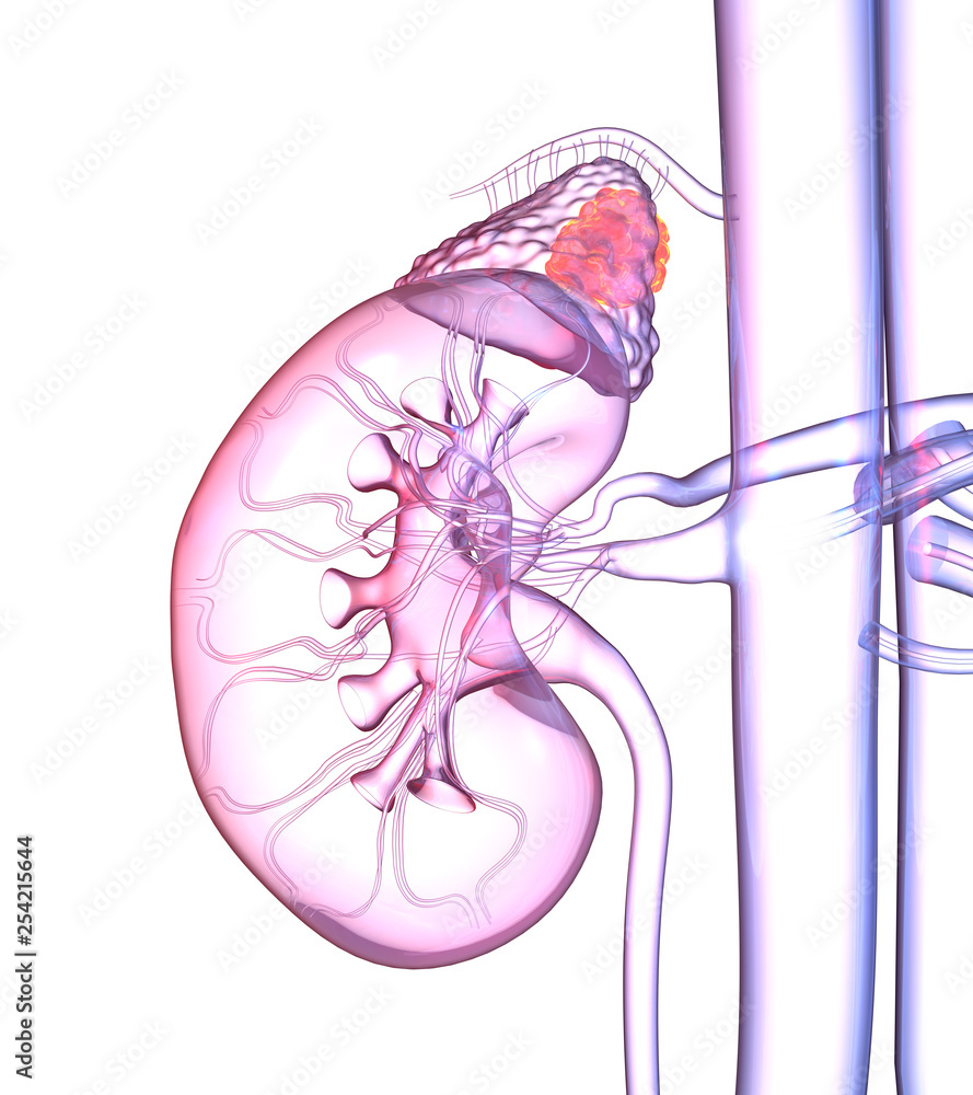 Fototapeta premium Adrenal glands tumor, colorful medically 3D illustration on white background