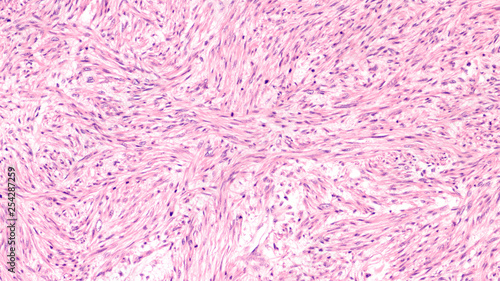 Microscopic image of a leiomyosarcoma, a type of soft tissue sarcoma of smooth muscle.  This malignant tumor typically occurs in the uterus or GI tract, but can occur from blood vessels elsewhere.  photo