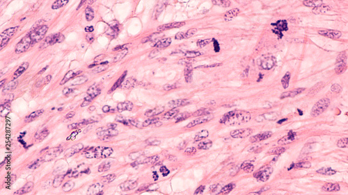 Microscopic image of a leiomyosarcoma, a type of soft tissue sarcoma of smooth muscle.  This malignant tumor typically occurs in the uterus or GI tract, but can occur from blood vessels elsewhere.  photo