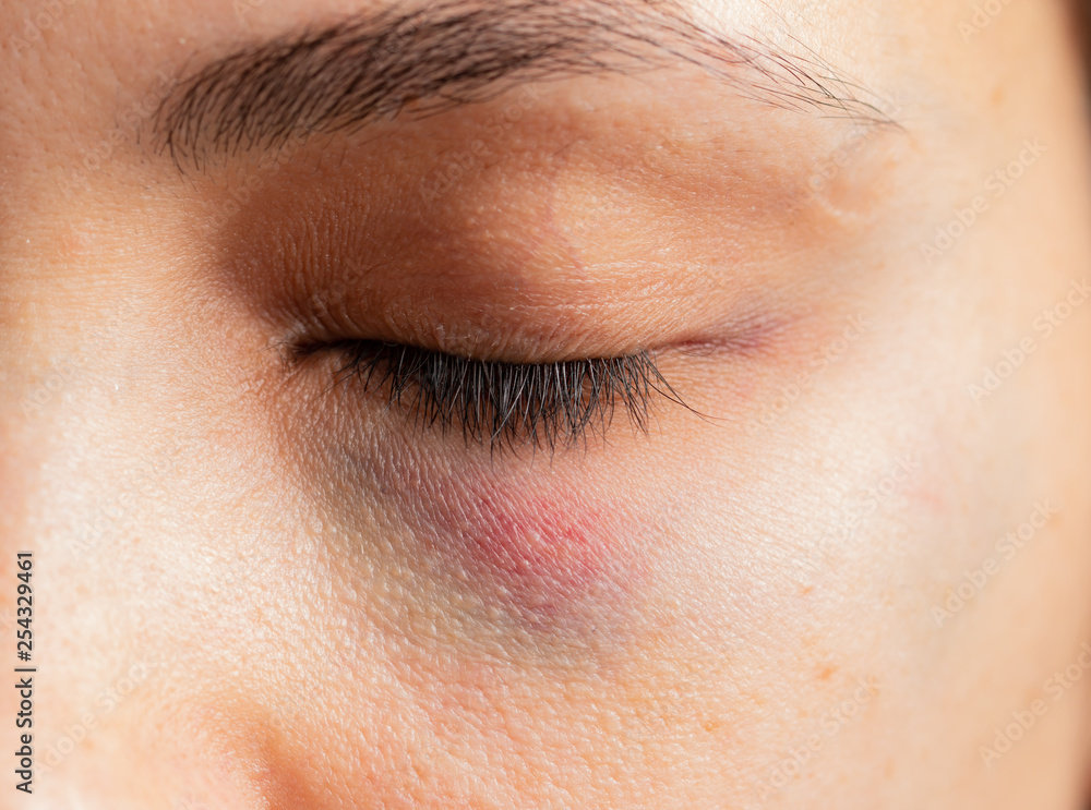 Obraz premium hematoma under the eye