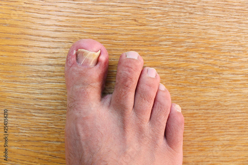 Obraz na płótnie Damaged toenail. The thumb on the man's leg. Top view.