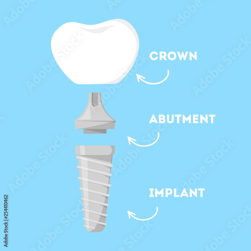 Dental implant structure. Parts of artificial tooth
