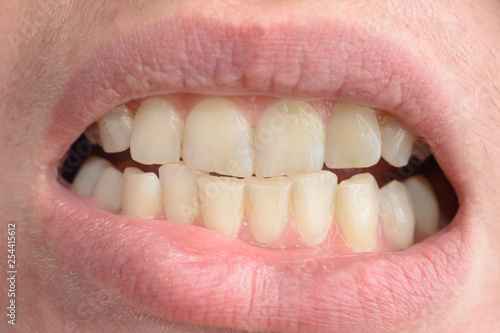 Billede på lærred A young woman shows her crooked teeth that needs medical help in close-ups