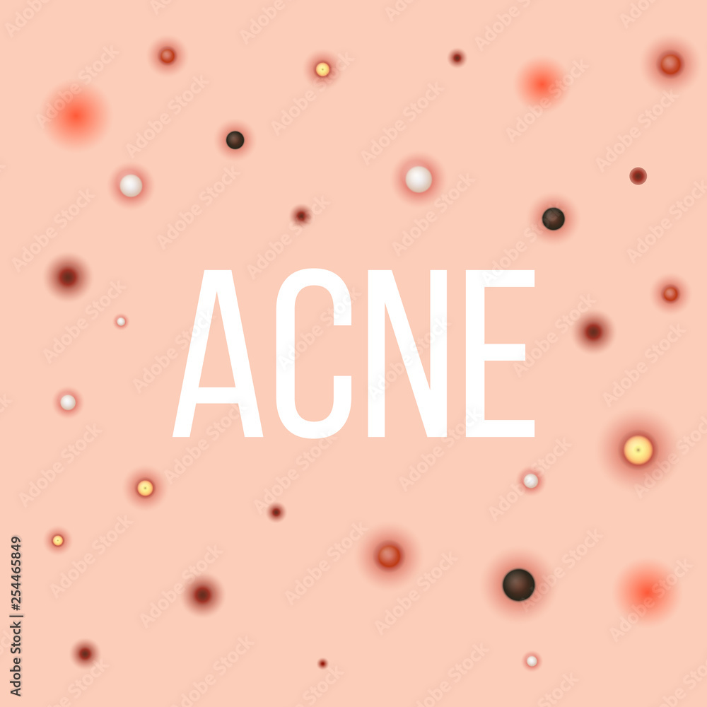 Creative vector illustration types of acne, pimples, skin pores