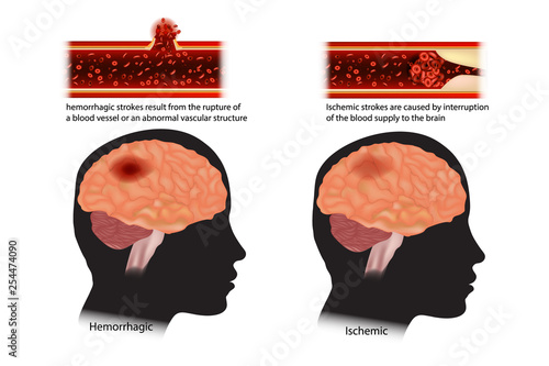 Diagram of the two types of stroke. Strokes classified: ischemic and hemorrhagic