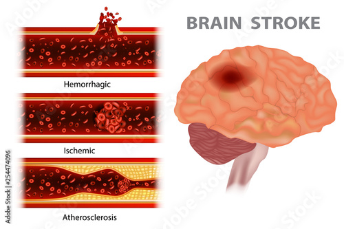 Types of stroke: Atherosclerosis, Ischemic, Hemorrhagic photo