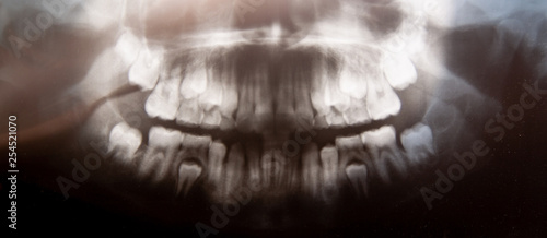 Panoramic dental x-ray of child photo with milk teeth and first molar teeth. selective focus. Health care, dental hygiene and happy childhood concept.