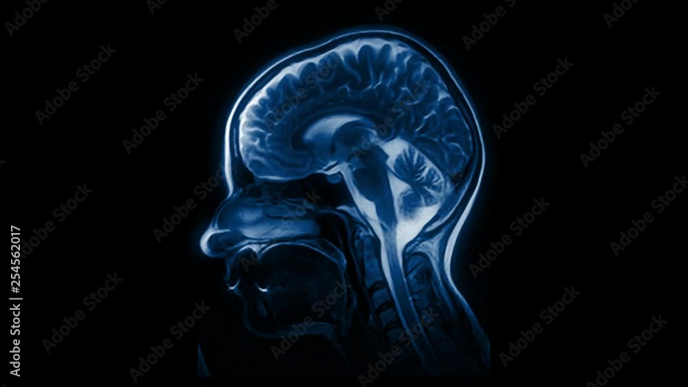 Computed medical tomography MRI upscaled scan of healthy young female head. Side view. Discrete slices. Blue/teal on black background. Computed medical tomography MRI upscaled scan of healthy young female head. Side view. Discrete slices. Blue/teal on black background.