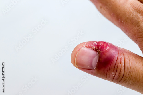 Paronychia, swollen finger with fingernail bed inflammation due to bacterial infection on a toddlers hand. finger swollen with inflammation due to Nail ripped infection.