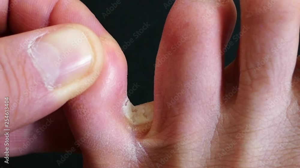 athlete's foot, ringworm between the toes, Fungal disease between toes
