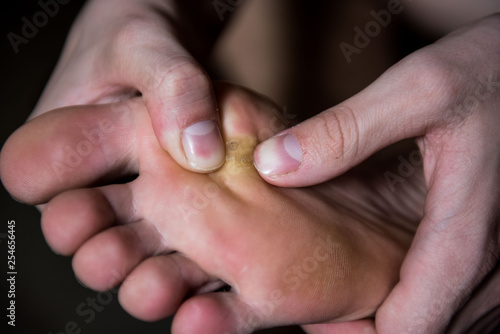 Corn on foot close up