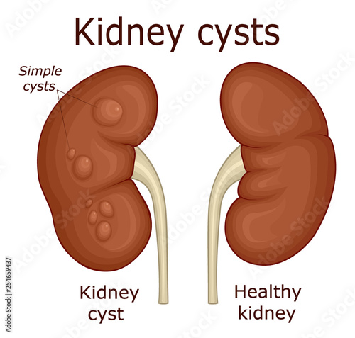 Illustration of kidney cysts