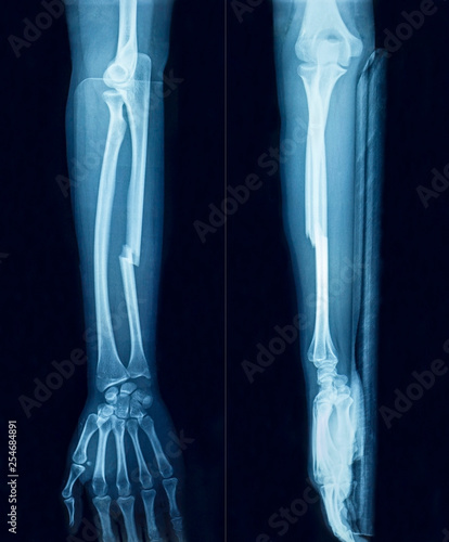Film x-ray show fracture plate of arm for fix arm’s bone