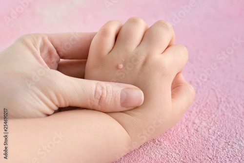 The doctor holds a small hand of a child affected with warts with selective focus on blurred pink background. Papillomavirus in a child's hand and fingers. Pediatric dermatology. Skin diseases photo