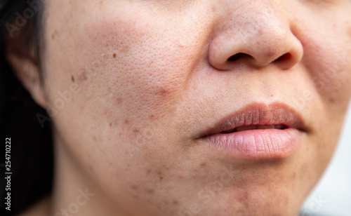 Problems facial skin is acne and blemishes.