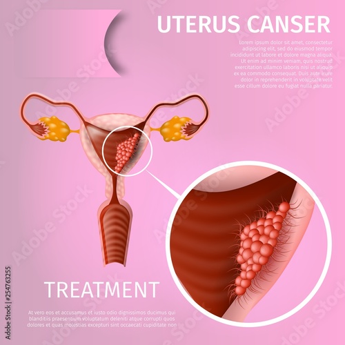 Oncological Disorder of Female Reproductive System