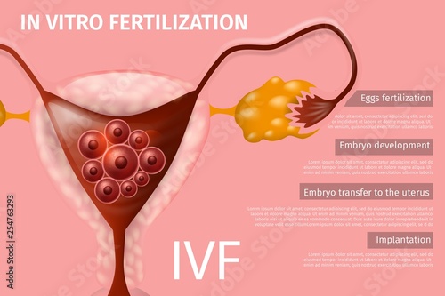 Womans Eggs In Vitro Fertilization, Implantation