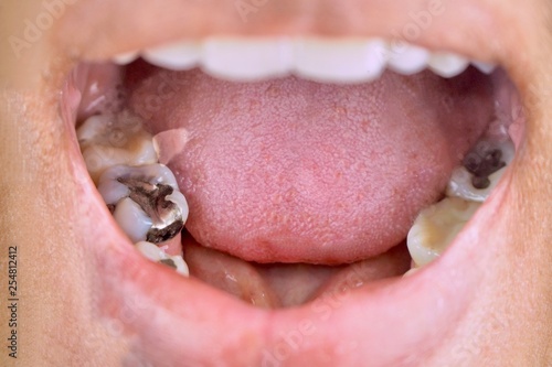 Photography Oral health, tooth decay due to poor cleaning, treatment of tooth fillings