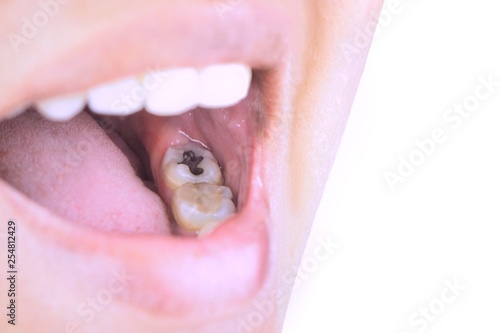 Oral health, tooth decay due to poor cleaning, treatment of tooth fillings.