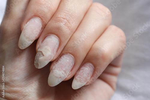 Damage of the nail after using shellac. © Liliia