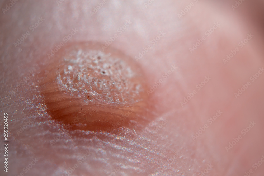 Verruca on hand. Moles or warts removing concept Verruca on hand. Moles or warts removing concept