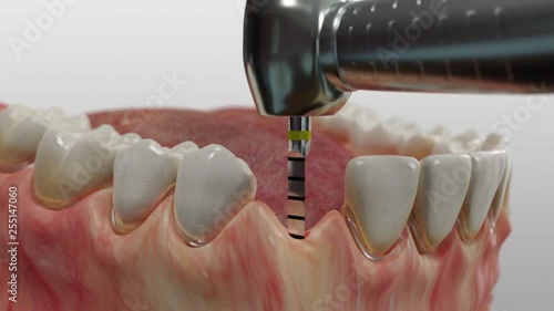 Wallpaper Mural Insertion eines Titan-Vierkant-Implantats im Unterkiefer mit Einsetzen der zahnkrone Torontodigital.ca