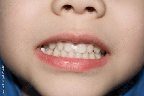 Teeth baby white healthy strong calcium for medicine design