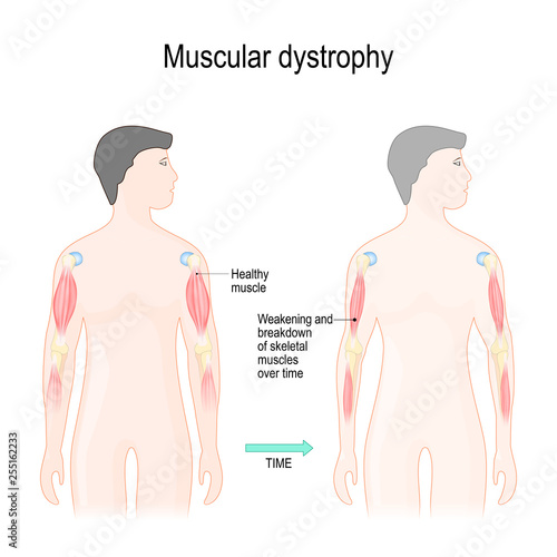 Muscular dystrophy photo