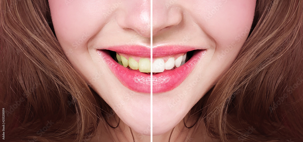 Bleaching of teeth. Before and after. Stock Photo | Adobe Stock
