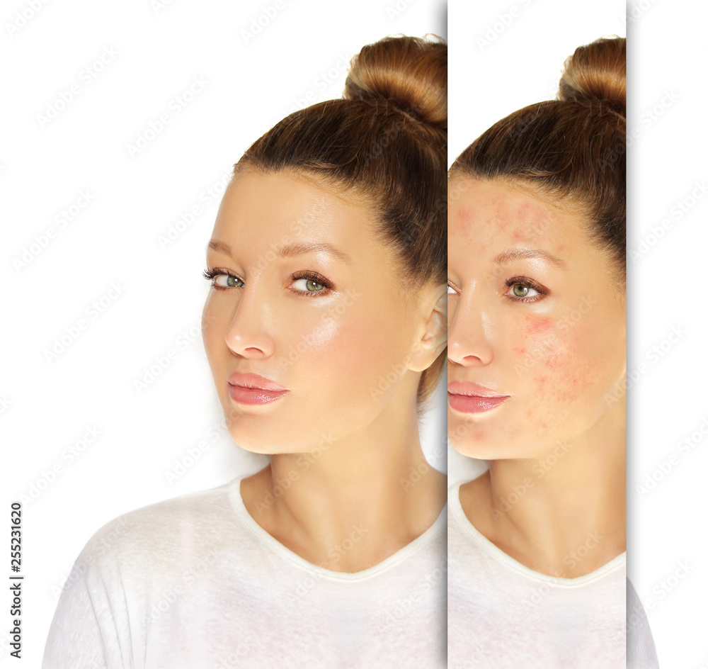 Post-Acne Marks /Treating Acne Scars.Acne Scar Removal Post-Acne Marks /Treating Acne Scars.Acne Scar Removal