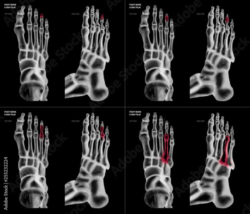 Canvastavla X-ray film collection of Ring toe foot bone with red highlights on different pain and joint area-top and side view-Healthcare-Human Anatomy and Medical concept-Isolated on black background
