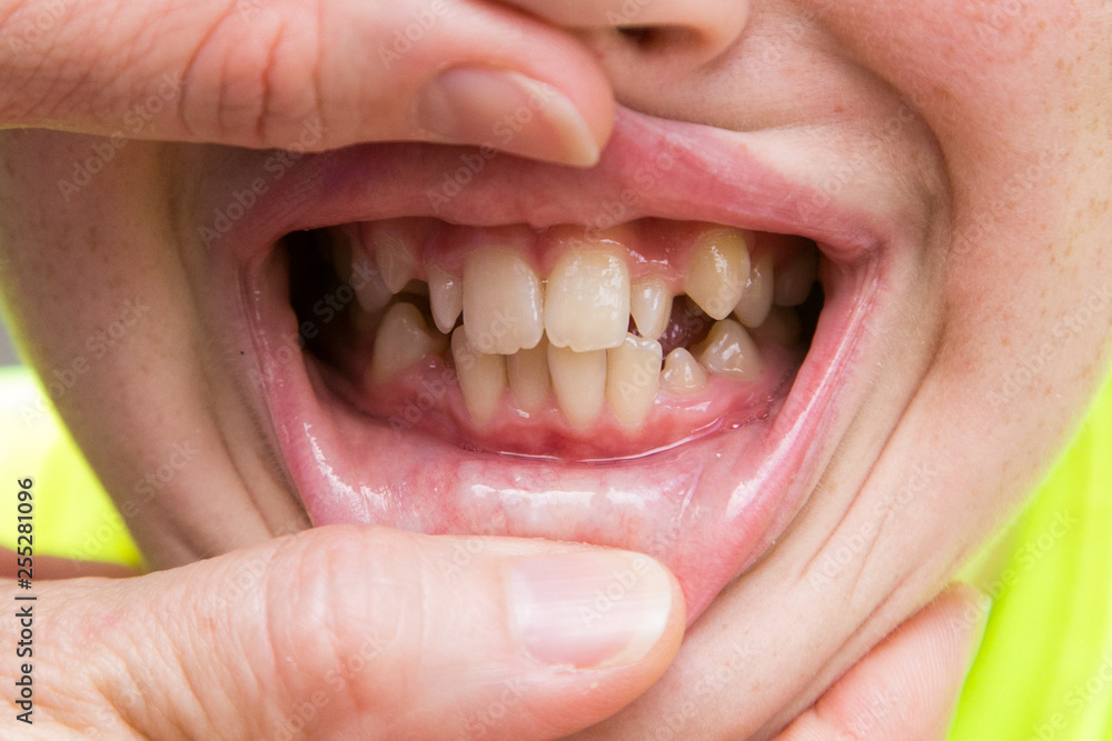 Fototapeta premium Crooked Teeth that Need to Be Fixed and Straightened Using Braces